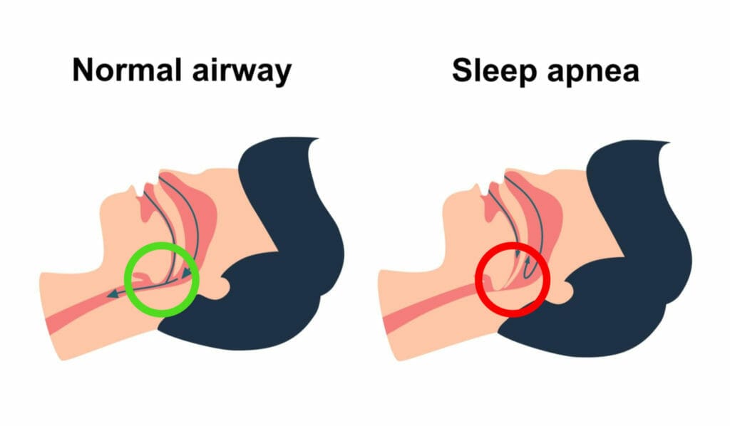 Side-by-side diagram comparing a normal airway to a blocked airway in sleep apnea