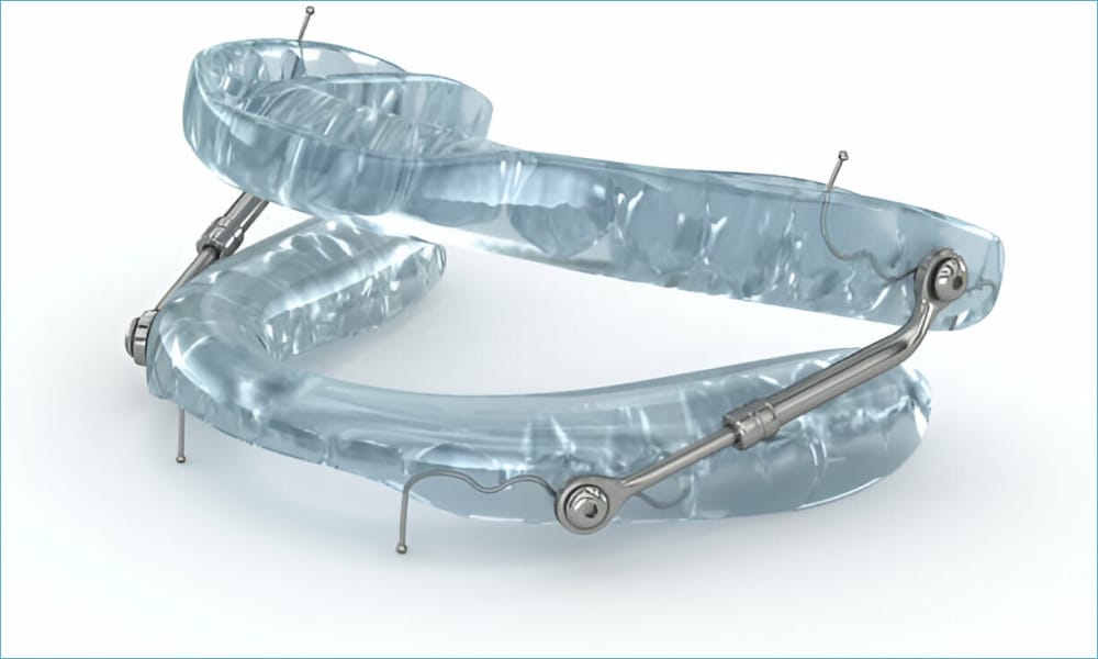 oral appliance device
