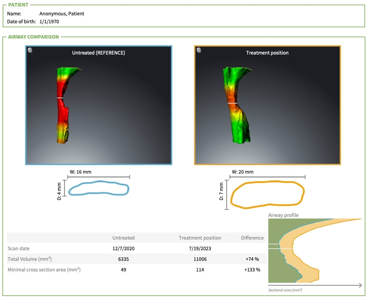 case study of mandibular advancement device