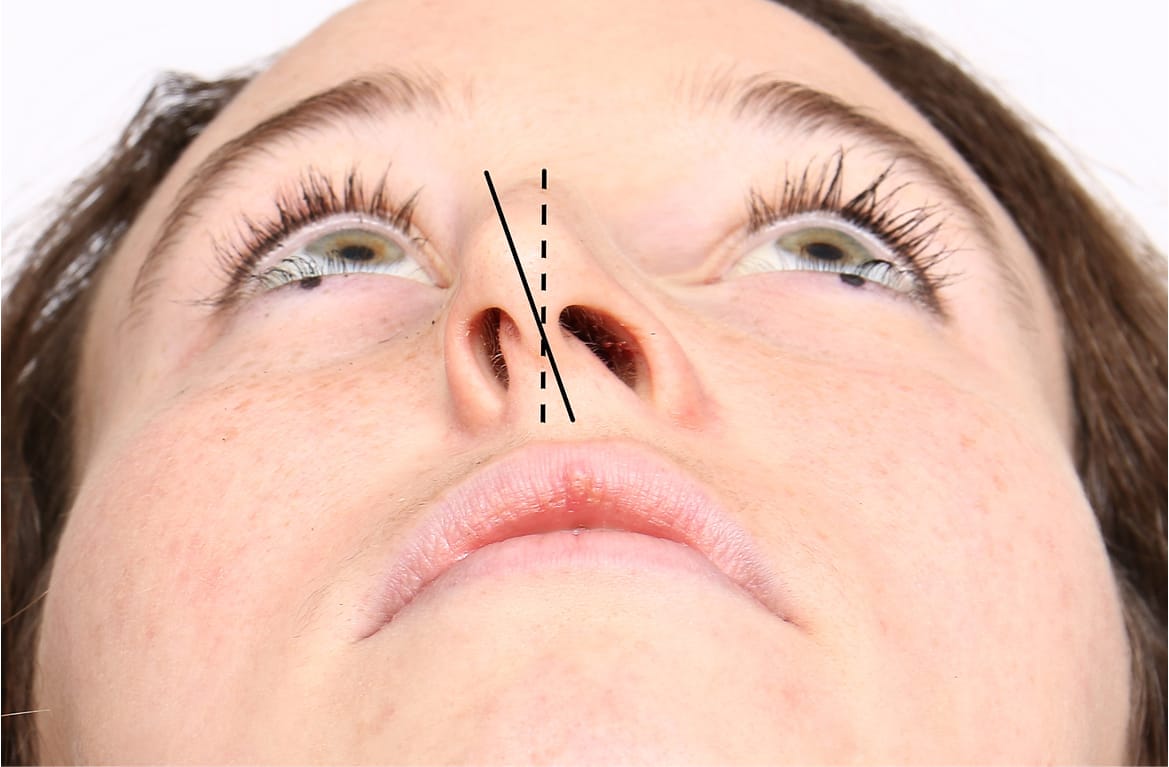 A close-up of a woman's face from below shows a visibly deviated nasal septum with marked lines